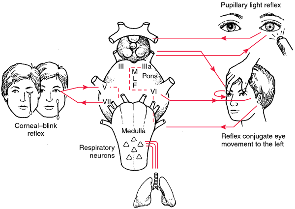 Myxedema Coma Definition Of Myxedema Coma By Medical Dictionary