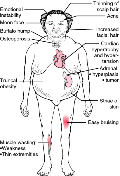 Cushing Sydrome Definition Of Cushing Sydrome By Medical Dictionary