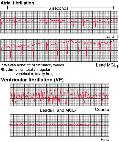 ventricular fibrillation vs atrial fibrillation