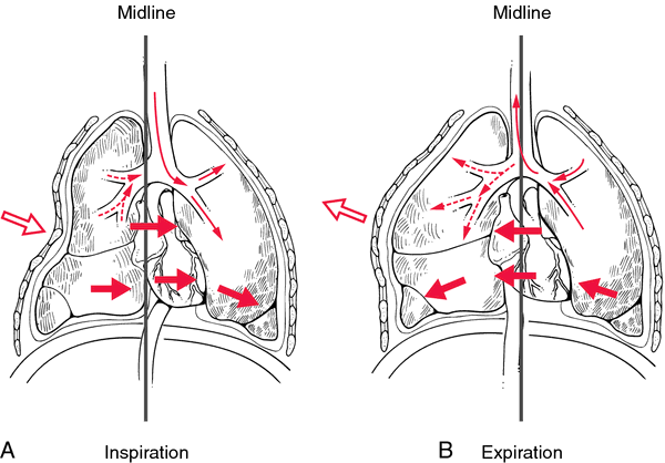 Flail  definition of flail by Medical dictionary