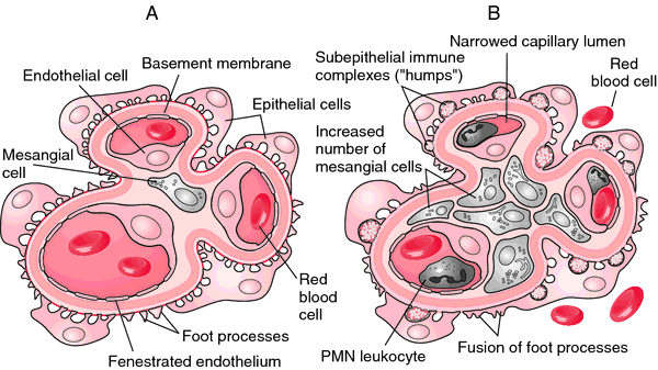 diffuse proliferative glomerulonephritis em