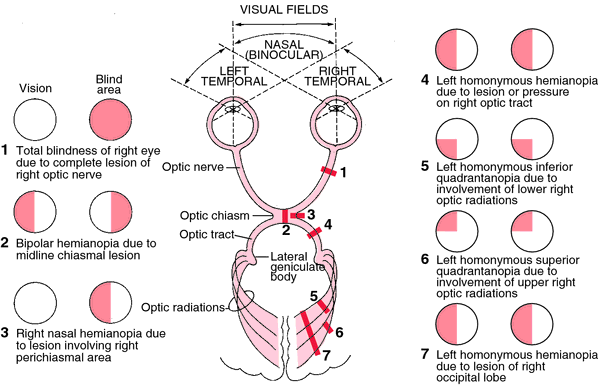 Hemianopsia; Hemianopsia Binasal; Hemianopsia Bitemporal; Hemianopsia ...