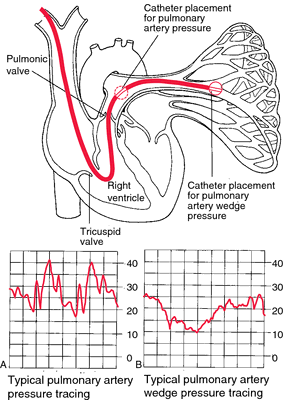 Hemodynamic Monitoring Definition Of Hemodynamic Monitoring By Medical Dictionary