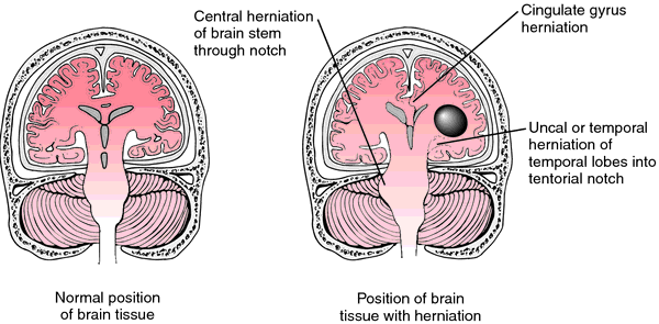 uncal herniation cranial nerve 3