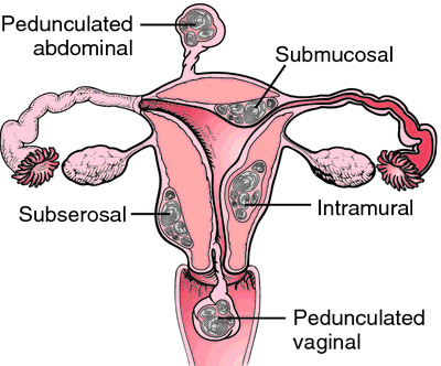 Pink Vaginal Discharge, Houston Fibroids