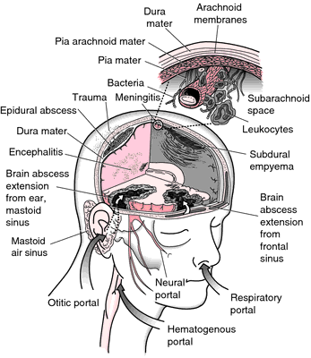 haemophilus influenzae meningitis precautions