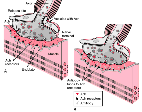 acetylcholine receptor myasthenia gravis