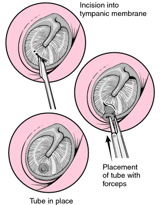 Description of operation for grommet /ventilation tube insertion