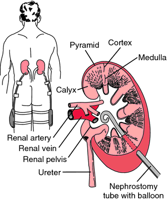 percutaneous nephrostomy