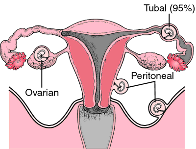 Ectopic pregnancy - Wikipedia