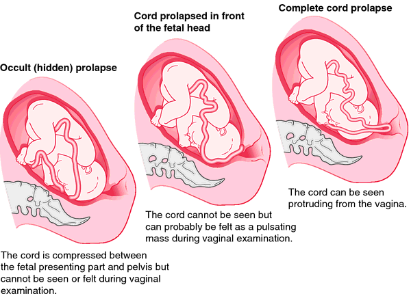 Prolapse Part 1: What is Prolapse? — Ladner Village Physiotherapy