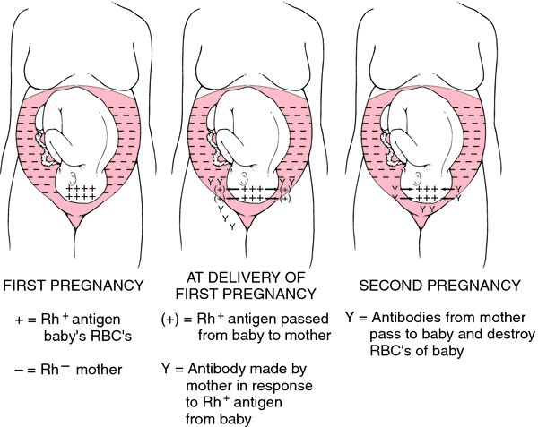pregnancy a negative blood type