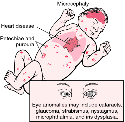 congenital rubella pda