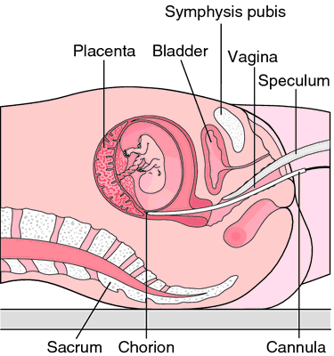 chorionic villus sampling