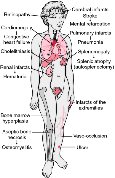 sickle cell symptoms