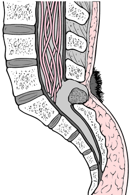 spina bifida hair patch