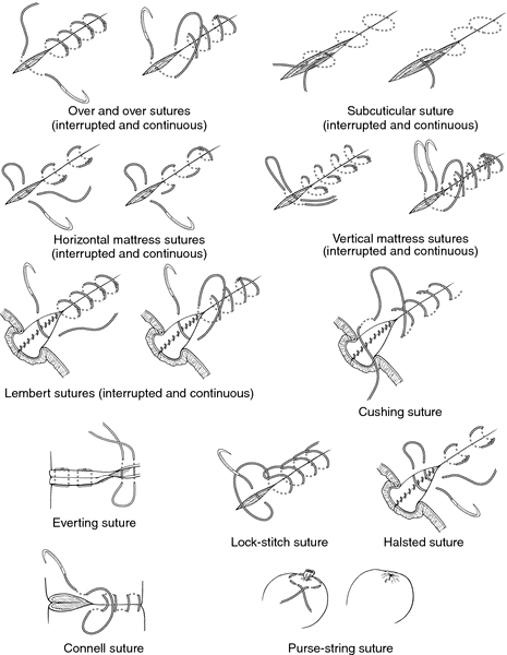 Double-nylon purse-string suture in closing postoperative wounds following  endoscopic resection of large (≥ 3 cm) gastric submucosal tumors