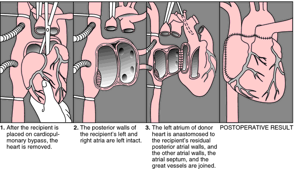 orthotropic transplant