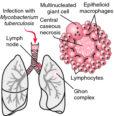 Tuberculosis Lungs Diagram