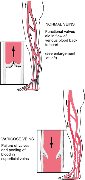 Varicose Definition Of Varicose By Medical Dictionary