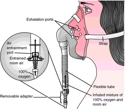 air entrainment mask