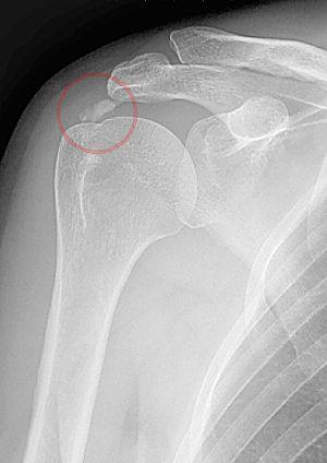 Calcific tendinitis marked.jpg