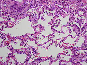 Histology of chronic hypersensitivity pneumonitis.jpg