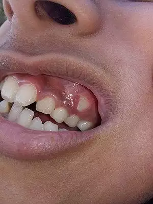 Dental problem in 10-year-old girl - 1.jpg